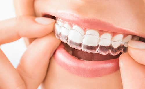 Invisalign